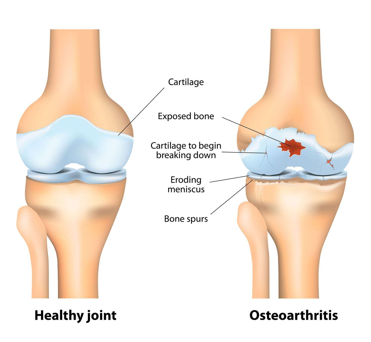 Osteoarthritis joint pain