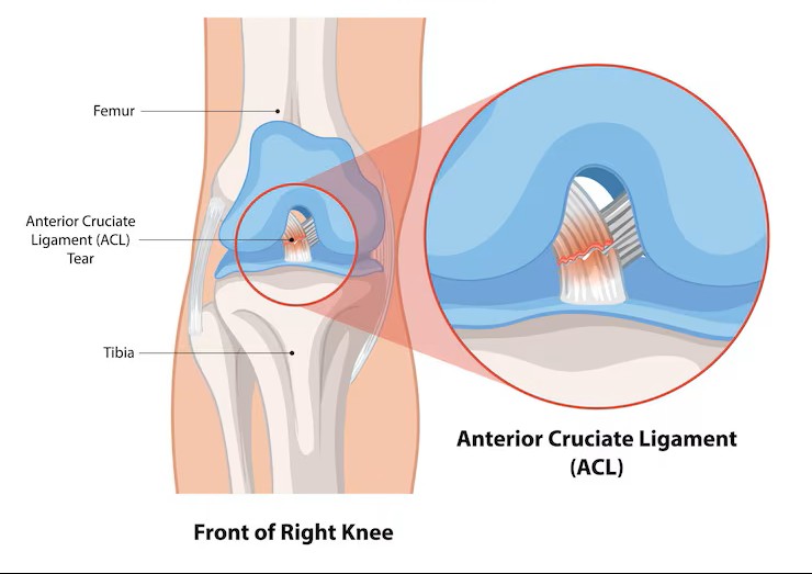 ACL Reconstruction treatment at Dr. G.K's Advanced Bone and Joint Centre