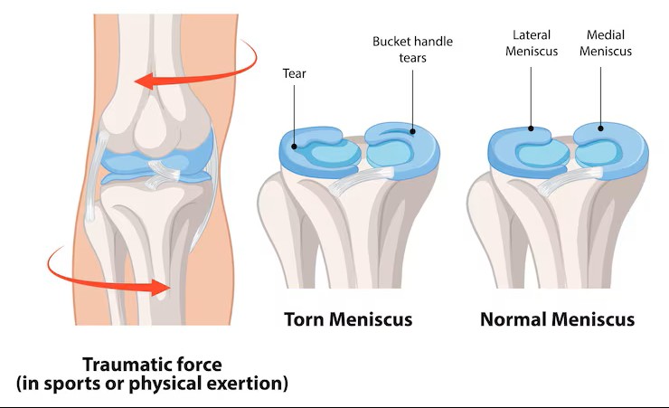 Meniscus Surgery treatment at Dr. G.K's Advanced Bone and Joint Centre