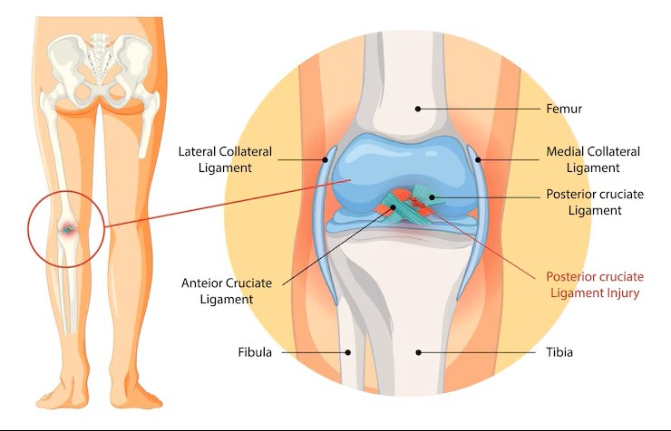 PCL Reconstruction treatment at Dr. G.K's Advanced Bone and Joint Centre